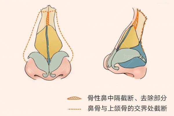 歪鼻矫正要多少钱?歪鼻矫正风险不大6-12个月就能复原有效改善歪鼻