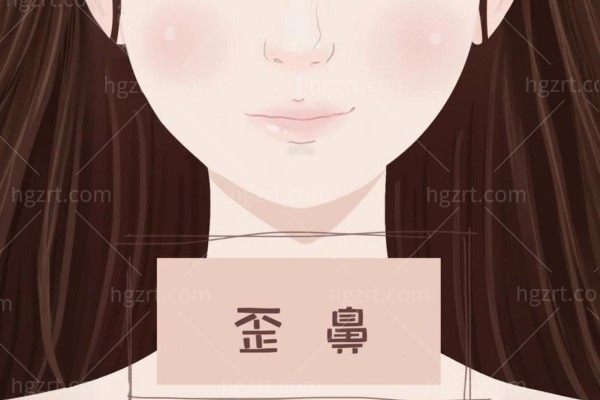 歪鼻矫正要多少钱?歪鼻矫正风险不大6-12个月就能复原有效改善歪鼻
