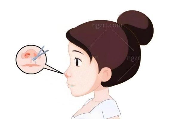南昌隆鼻修复医生推荐