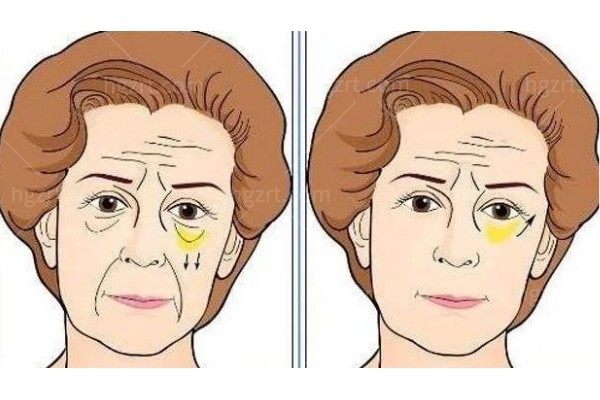 打眼周肽半月后为啥眼周越来越干怎么办？