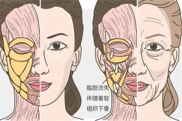 想改善法令纹和下垂的苹果肌，问下英伦大提升都打哪些部位