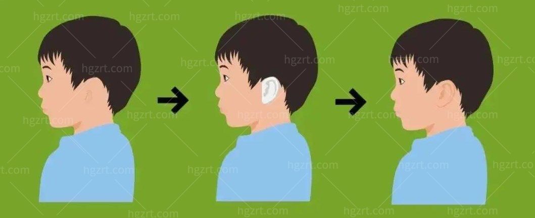 小耳畸形是什么原因造成的