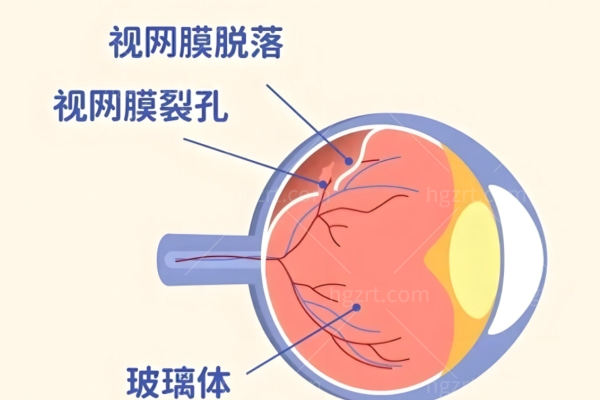 视网膜脱落取油后几天复原视力?为什么取油后视力复原不能急?视网膜脱落医院名单大揭秘