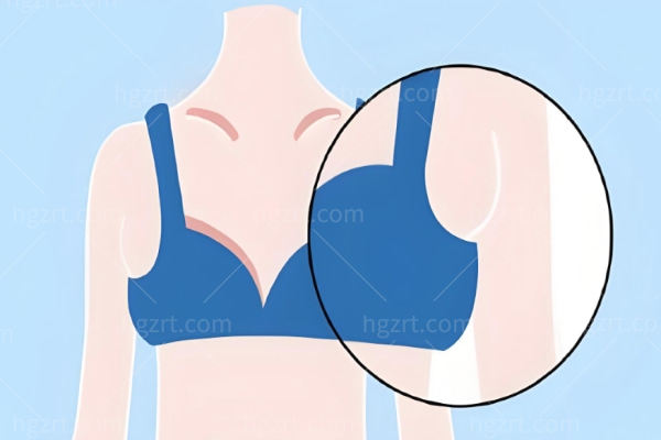 吸脂去副乳价格贵吗