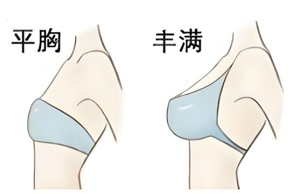 人工韧带提胸哪里可以做?人工韧带提胸术会凹凸不平吗?能维持多久?