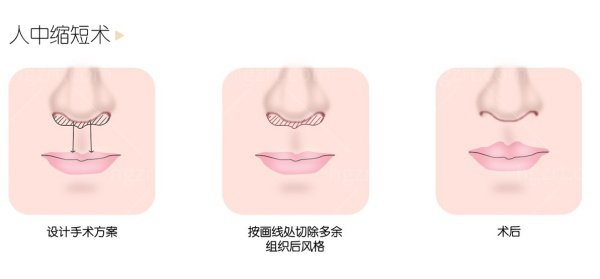 深圳人中缩短术哪个医院做的好