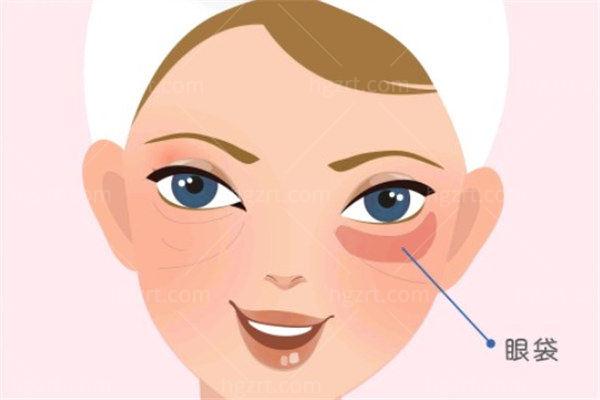 无-创祛眼袋会反弹吗