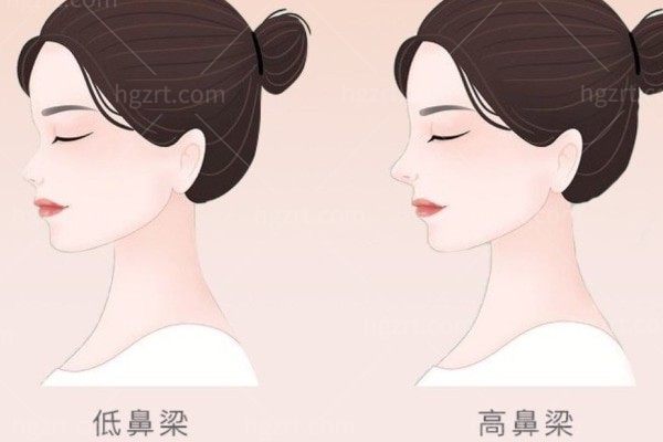 想改善鼻头圆钝和鼻子整体立体感，问下鼻小柱延长和垫鼻尖一样吗?