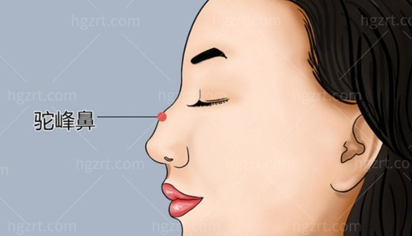 国内微驼峰鼻做得好的医生有哪些