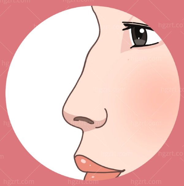 国内微驼峰鼻多少钱