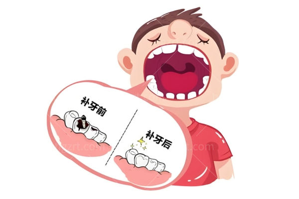 牙齿龋坏的类型有几种?六种牙齿龋坏典型洞型分享供大家参考避雷
