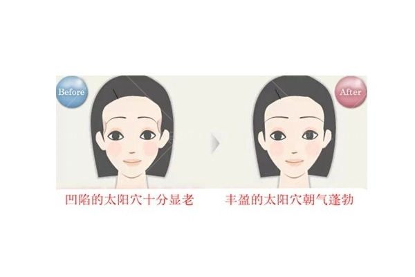 膨体填充太阳凹陷多少钱