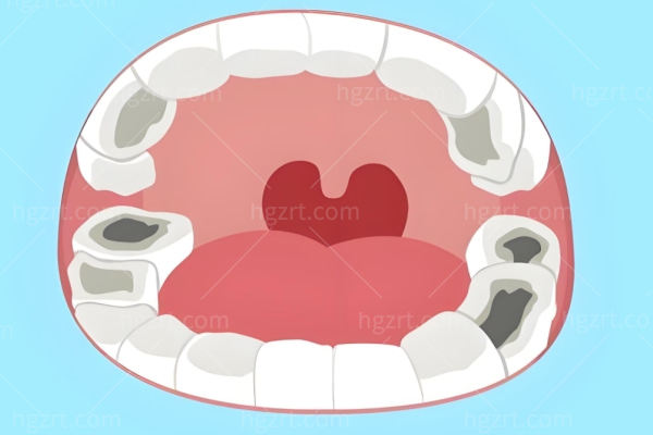 牙齿龋坏不治疗会怎样?从酸爽到要命,从烂到碎到没,小洞不补大洞吃苦