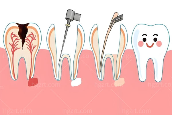 牙齿龋坏不治疗会怎样?从酸爽到要命,从烂到碎到没,小洞不补大洞吃苦