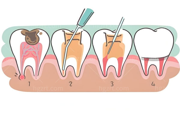 牙齿龋坏有什么症状?龋坏达牙本质中层是什么龋?尽早抓住补牙黄金窗口期