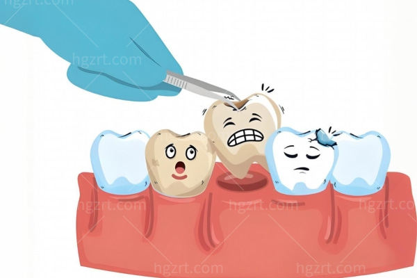 牙齿龋坏有什么症状?龋坏达牙本质中层是什么龋?尽早抓住补牙黄金窗口期