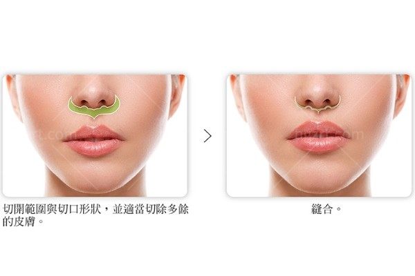 人中缩短需要用去疤膏吗
