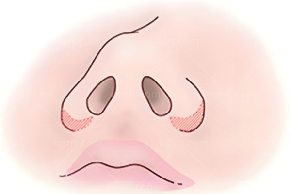 缩鼻翼 (2).jpg
