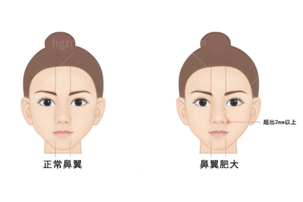 上海王玲医生缩鼻翼多少钱