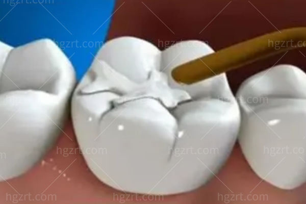 激光补牙和普通补牙哪个好?激光补牙是什么原理?能维持多久?