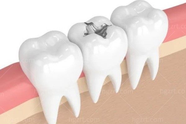 想问下大家:直接补牙好还是根管治疗好？