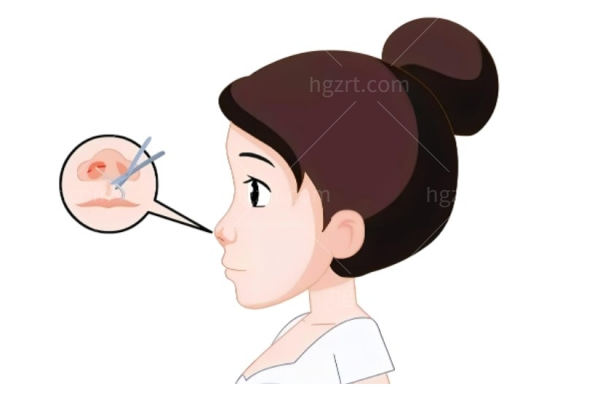 南京挛缩鼻修复医院排名推荐:艺星/画美/施尔美等技术可靠