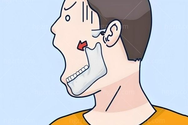 3D打印人工骨修复下颌角怎么样