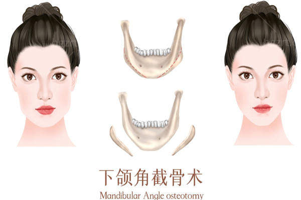 3D打印人工骨修复下颌角多少钱