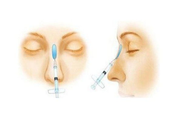 玻尿酸隆鼻用大分子还是小分子？