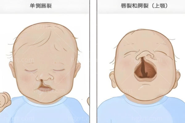 唇裂手术后鼻孔不对称怎么办