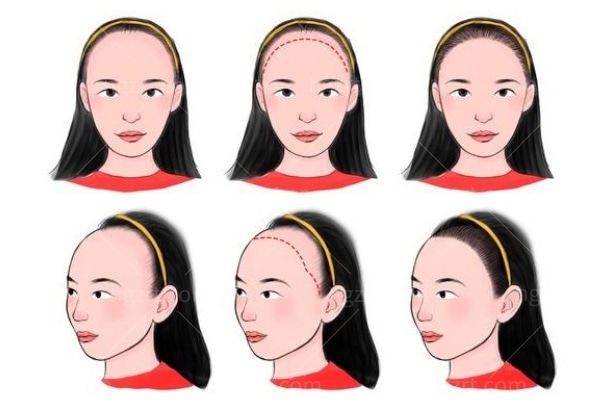 纹发际线自然吗？纹发际线和植发哪个好？看完这篇不纠结！