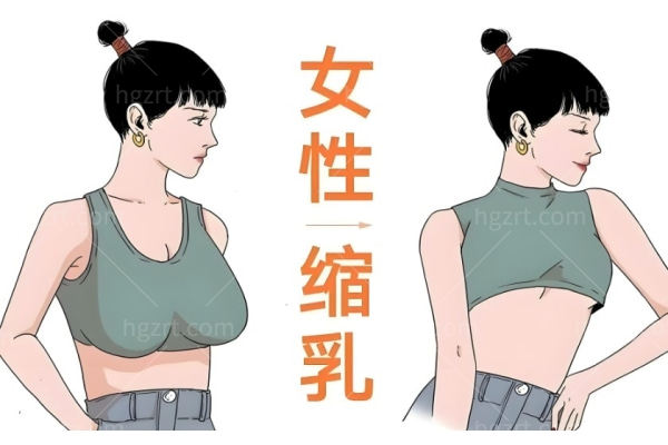 贵阳缩胸手术多少钱