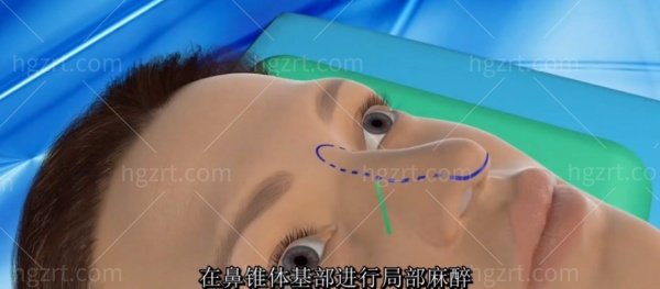 韩国GNG整形医院男士鼻整形多少钱