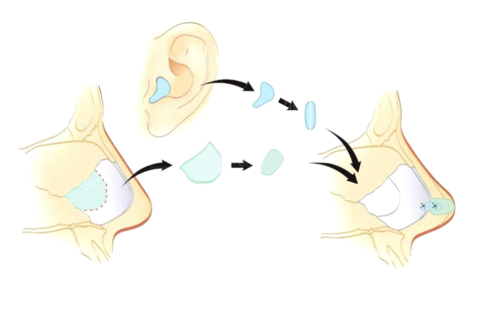 为什么选成都东篱段伟强做耳再造