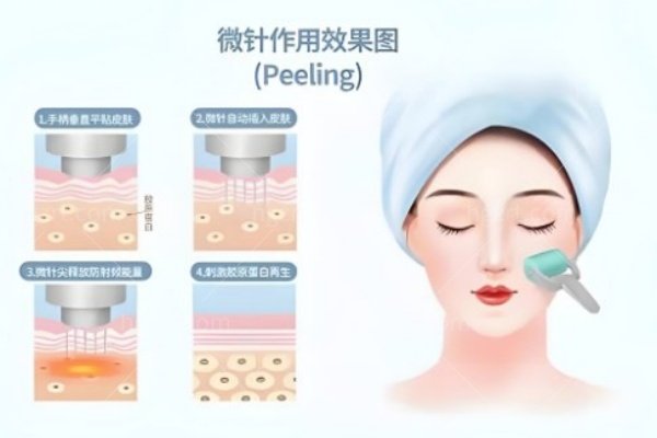 广州做半岛黄金微针多少钱？四代黄金微针：3000-6000元