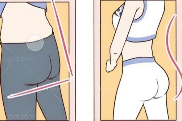 深圳福雅做丰臀到底行不行？深圳福雅胡俊杰假体丰臀技术实力一绝！