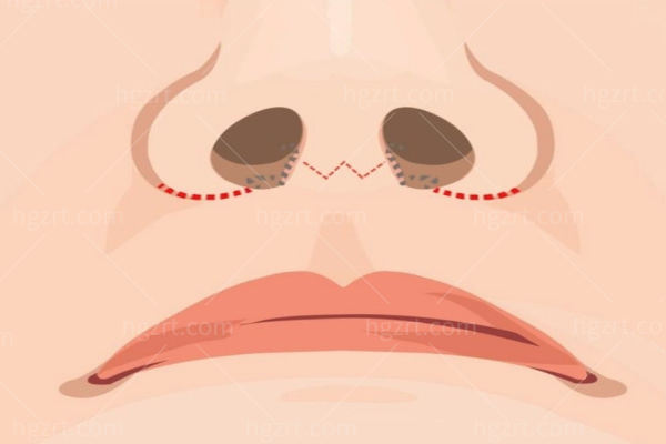 北京沈微做人中缩短多少钱