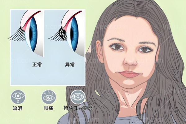 一根下睫毛倒长扎眼睛做电解手术需要多少钱
