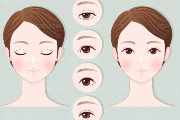 上海华美做眼睛怎么样？上海华美佀同帅/胡小清做眼睛很出名