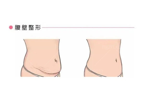 重庆长城骨科医院腹壁成形多少钱