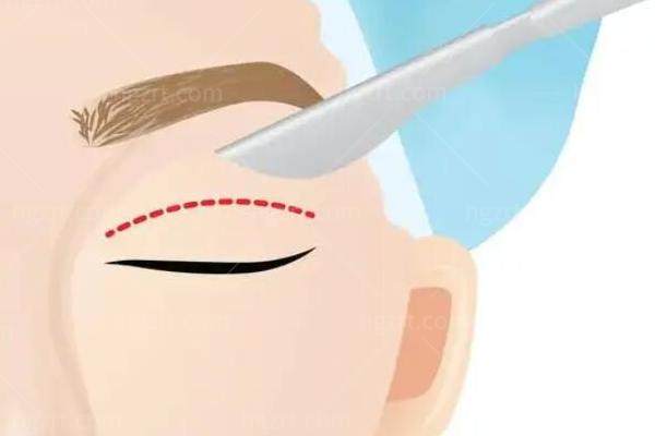 武汉双眼皮修复医生怎么选