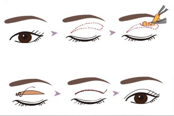 武汉双眼皮修复医生排名榜前十