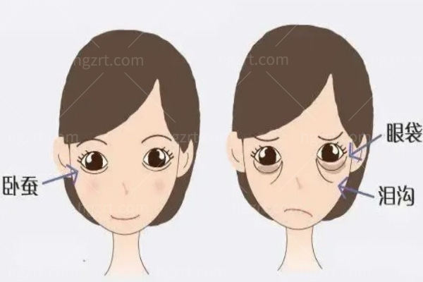 郑州王杨医生眼袋修复卧蚕多少钱