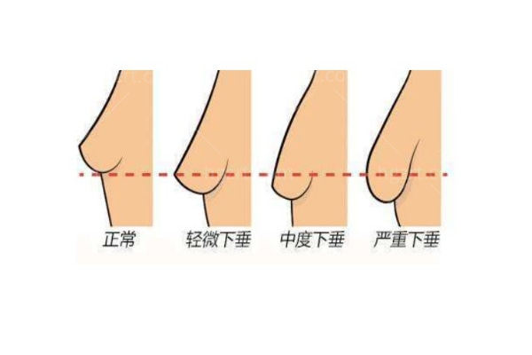 李建东维维胸下垂微创提升是坑吗