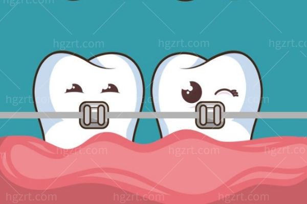 日本拓美陶瓷自锁托槽好不好