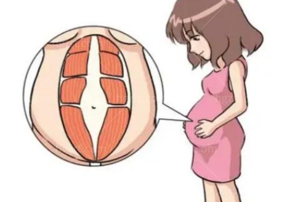 腹直肌分离怎么办