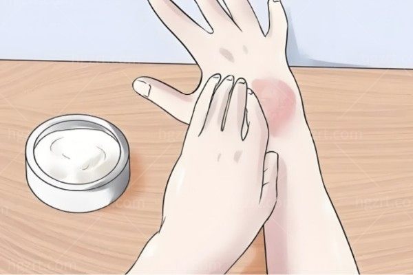 手臂上10多年的烟疤能用点阵激光去除吗？