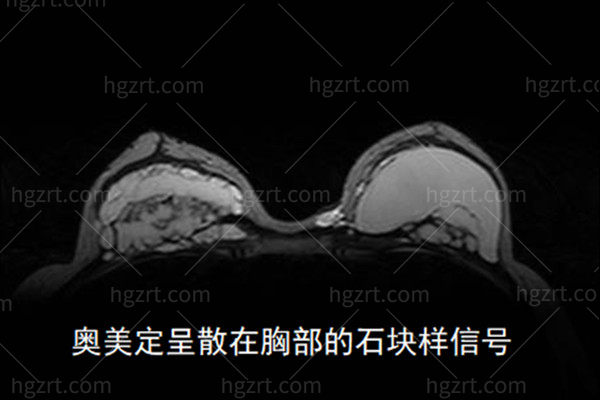 广州异物取出费用多少钱