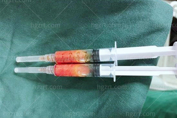 广州面部异物取出价格参考