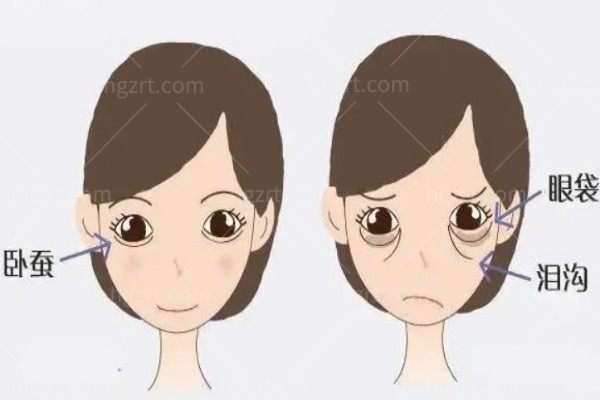 twinha玻尿酸可以打卧蚕吗？